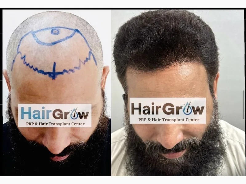 Hair transplant result, case 2 — before and after