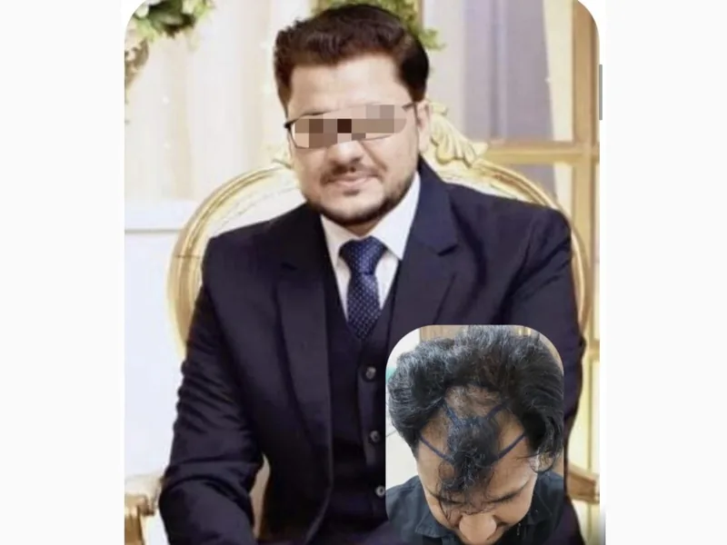 Hair transplant result, case 3 — before and after