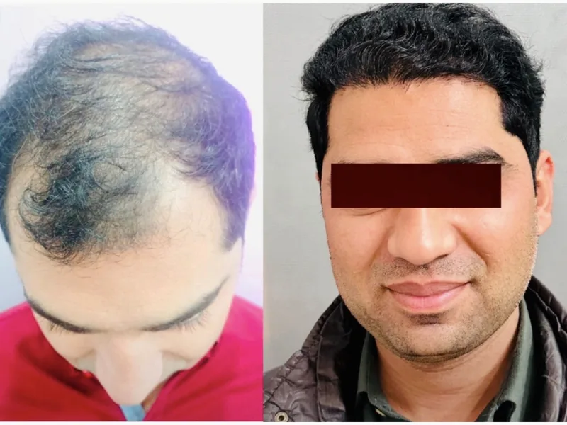 Hair transplant result, case 4 — before and after