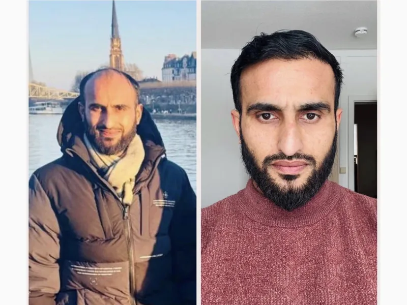 Hair transplant result, case 5 — before and after